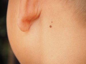 Tahi Lalat Timbul Pengaruh Genetika dan Paparan Sinar Matahari ( ? )